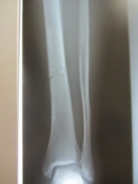 Tibia fracture as shown on X-ray
